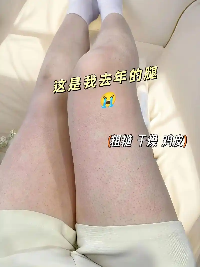 夏天的较量开始啦!和鸡皮肤说拜拜