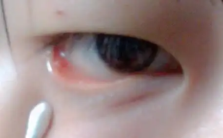 下眼睑内接近眼尾处有一块红色凸起的小肿块 不疼不痒的没有什么不适