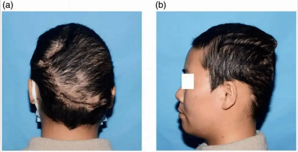 为了去掉一个「痣」,医生给她头皮灌入 4 个大水球_扩张_蒋敏_手术