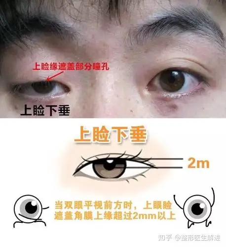 上睑肌无力的典型表现是上眼睑下垂,眼睑增厚.