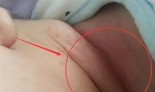 几块钱的红霉素眼膏,竟然这么厉害!|鼻炎|湿疹|疱疹|宝宝_网易订阅