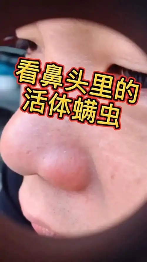 鼻子上01毫米的蠕形螨虫放大1000倍