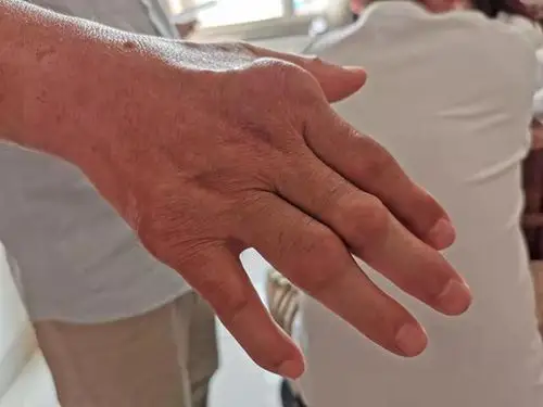 痛风十年,张大伯手指关节长满了"石头"