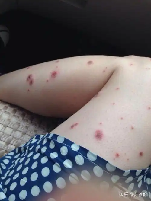 治湿疹好药_什么药治湿疹最好_什么药治湿疹效果最好