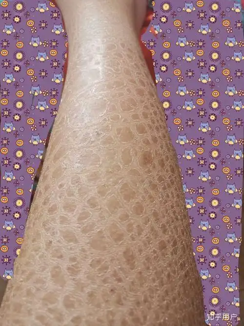 鱼鳞病还有未来吗?