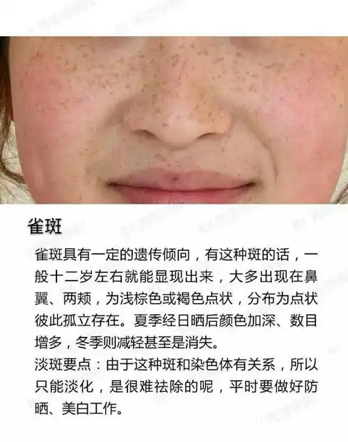 如果你脸上长了斑,那么你知道是什么斑吗?教你识别脸上的斑