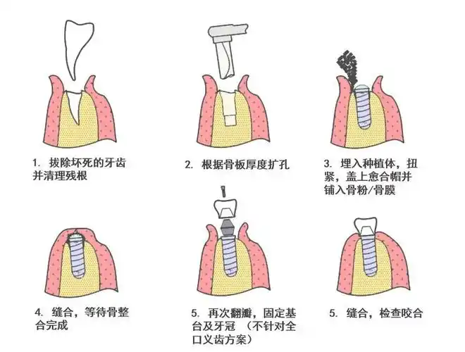种植牙大科普一颗完整种植牙组成