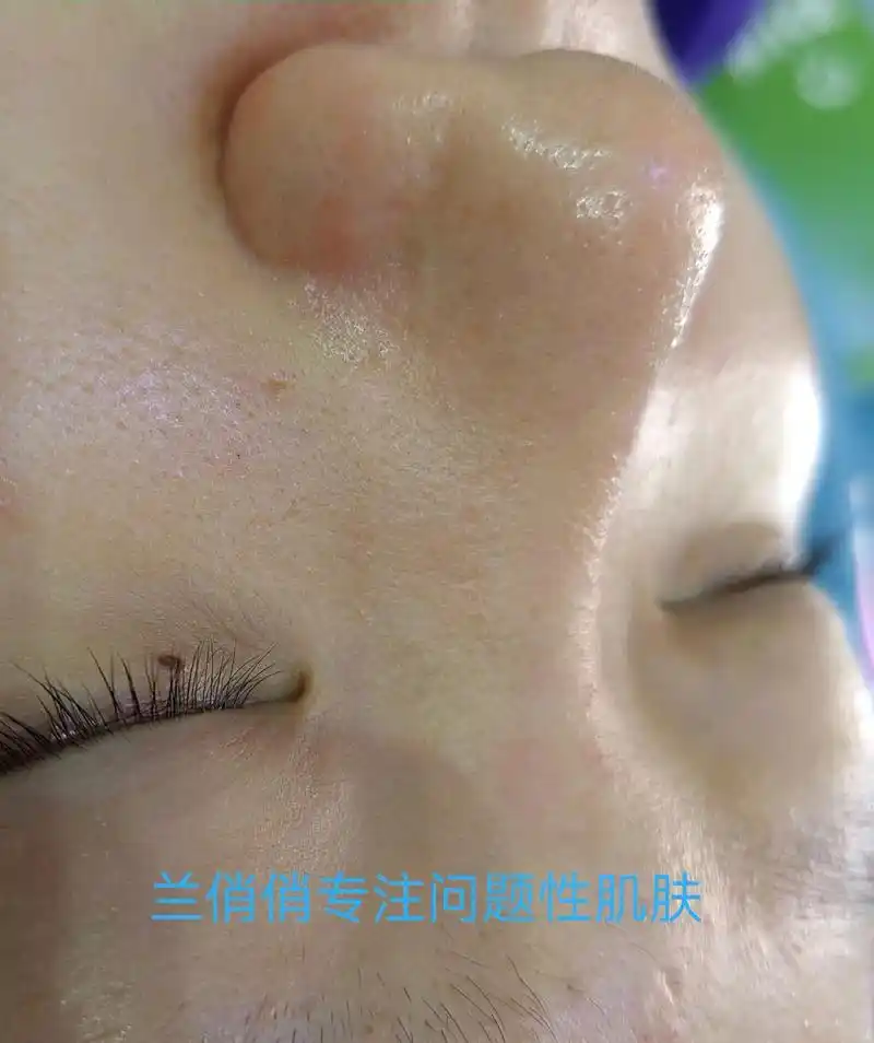 鼻子祛黑头螨虫收缩毛孔前后对比图95  无美颜无修图97 效 - 抖音