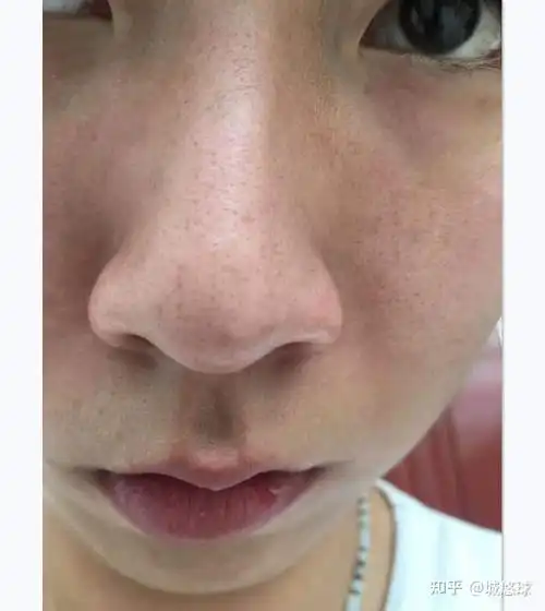 乳糖酸可以去鼻子上黑头和t区毛孔粗大吗?怎么使用.一天几次? - 知乎