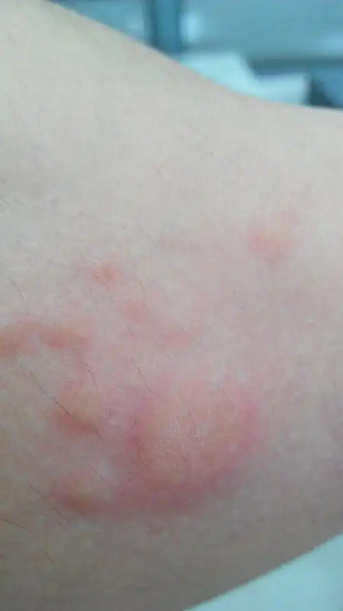 问:以前皮肤没有过敏过,就是喝酒脸红,6月份有次喝过啤酒后身体开始