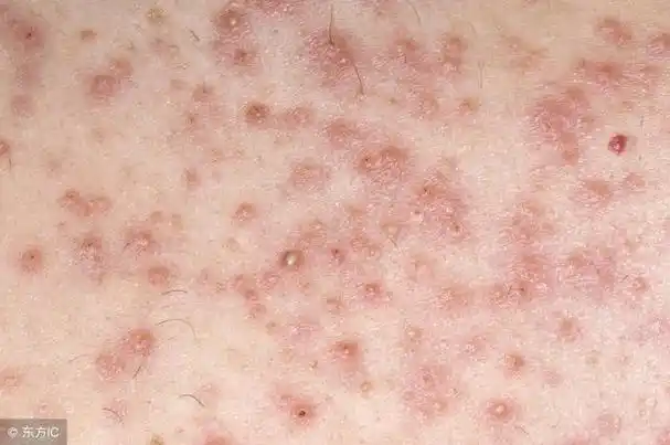 毛囊炎的症状及怎么根治方法,老中医秘方免费分享