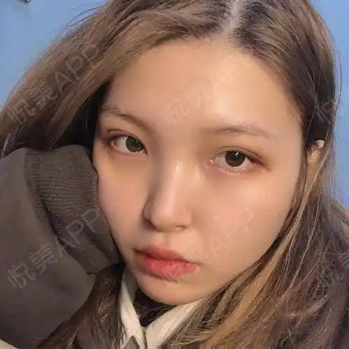 【美沃整形孔伟立双眼皮】