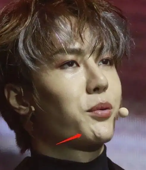 王一博 你的鼻子怎么疤痕如此严重