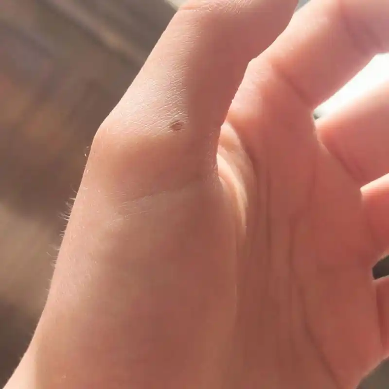 左手大拇指长痣 左手大拇指长痣,小时候长的,越长越大颜色越浅.