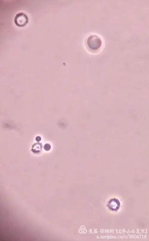 非新鲜尿中的棘形红细胞