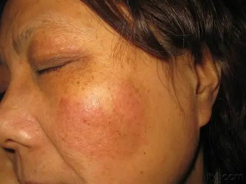 看图识病.面部神经性皮炎