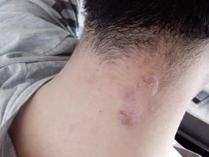 脖子上有块皮肤出问题了.具体请看图.用什么药膏好点