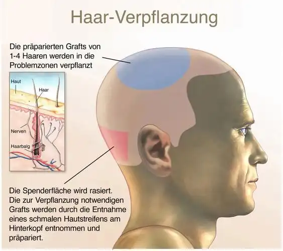 5种"脱发治疗方式"大pk,哪一种省钱又有效?