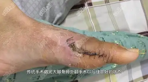 治疗大脚骨是选微创手术好还是普通手术好术后有后悔的没