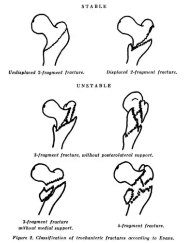 股骨转子间骨折02evans02分型到底应该怎么分