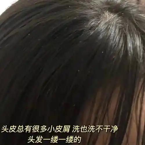 强力去油去屑的洗发水推荐_问题_头皮屑_头发