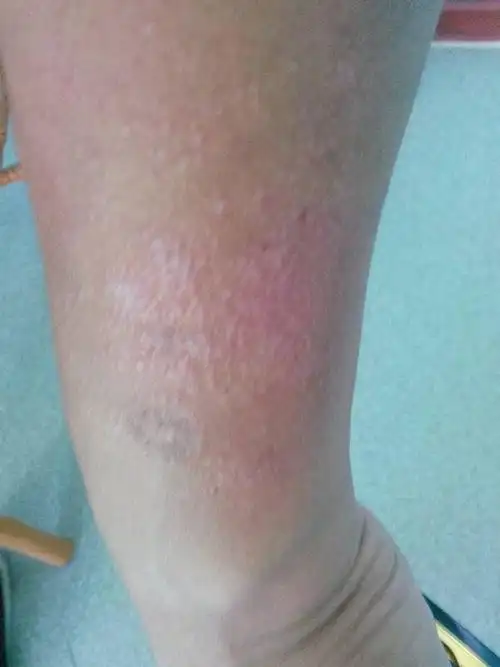 太阳一晒胳膊上就起这种小疙瘩,很痒,过几天就会没事,有没有大神知道