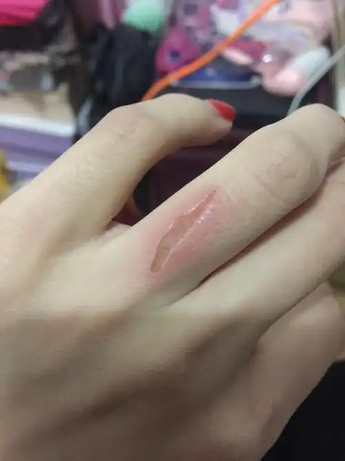 被衣架刮掉一层肉,有点深,沾水之后红肿,已经抹了碘伏,还需要包扎吗?