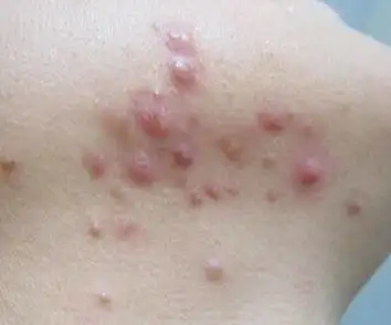 毛囊炎患者的护理需保持皮肤干净