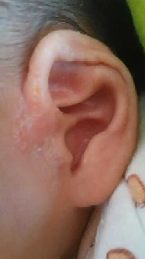 宝宝耳朵边流黄水结痂