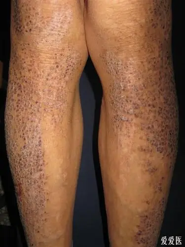 看图识病原发性皮肤淀粉样变