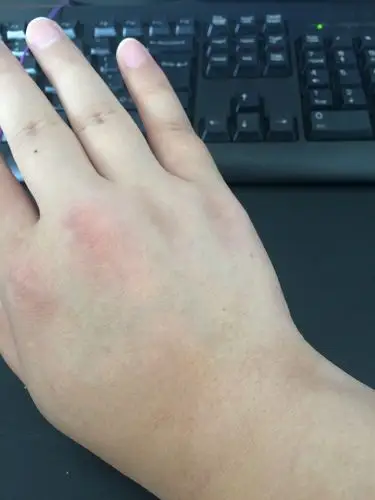 右手手背的皮肤颜色不一样好像癣一样一大块比其他部位的颜色白冬