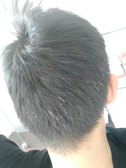 前额两鬓后脑勺长出白头发是什么情况可能不是衰老引起的