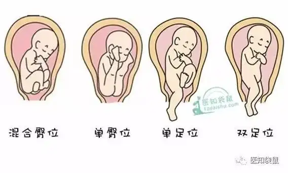 如果胎儿臀在下,头在上就叫臀位.