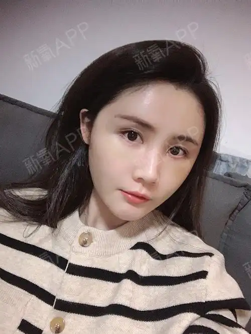 自体脂肪全面部填充恢复的第10天哈哈哈,自我感觉恢_圈子-新氧美容