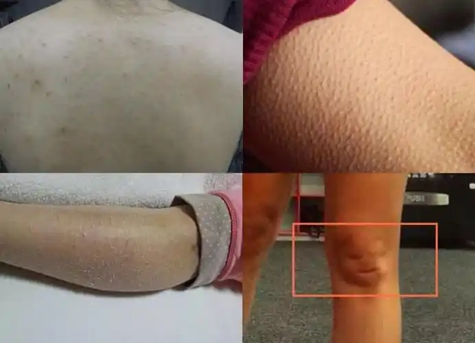 还会导致 水油失衡产生鸡皮,这也是为什么身体皮肤会 粗糙暗黄