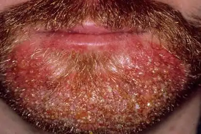 胡子毛囊炎的症状和图片