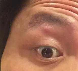 眼皮浮肿是怎么回事下眼皮浮肿是怎么回事