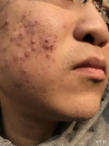 满脸痘痘的男生想开始护肤,有什么推荐吗?谢谢?