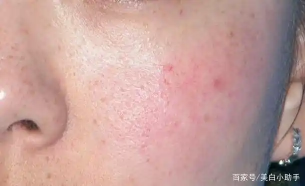 皮肤管理——修复敏感肌,去除红血丝,怎么管理效果最好?