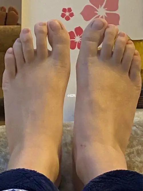 大脚趾内扣