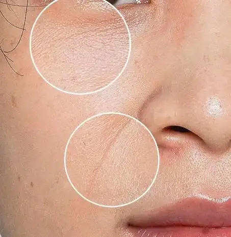 t区油意味着你的皮肤清洁不够,而眼部细纹的出现则可能是因为你的皮肤