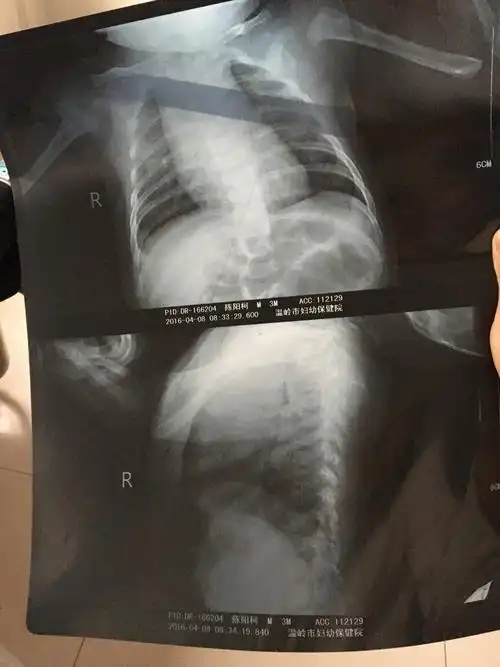 三个月宝宝肺炎住院三天了,刚开始是咳嗽拍片诊断肺炎的,住院第二天