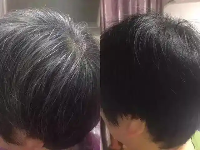 按摩10分钟白发变黑发,不伤头皮,毛囊 ,100%覆盖!