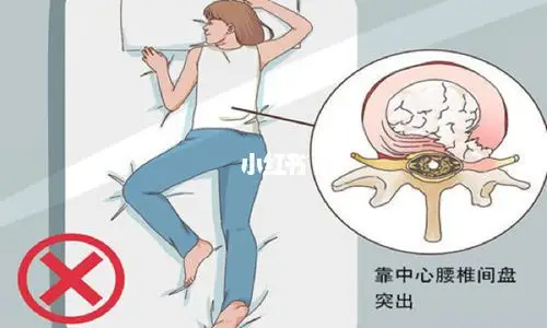 腰椎间盘突出正确睡姿