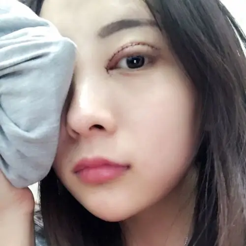 全切双眼皮开眼角第二天