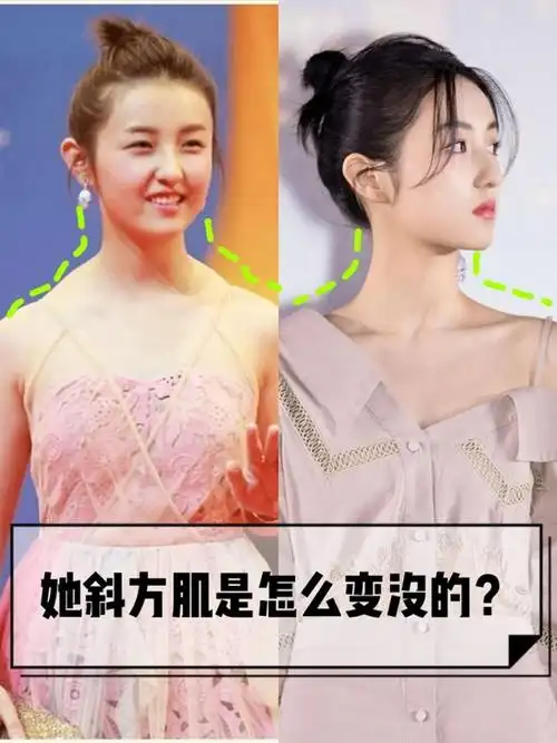 斜方肌发达,锁骨不明显,明明是个姑娘,远远一看,却_圈子-新氧美容整形