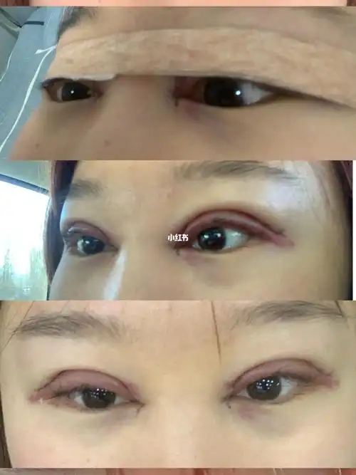 埋线双眼皮取出重新做的全切