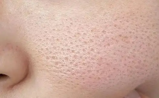 毛孔粗大怎么办?教你有效收缩毛孔的方法