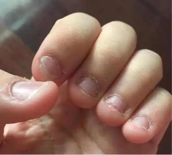 从小喜欢"啃指甲"的孩子,长大后大多是这2种性格,心疼孩子