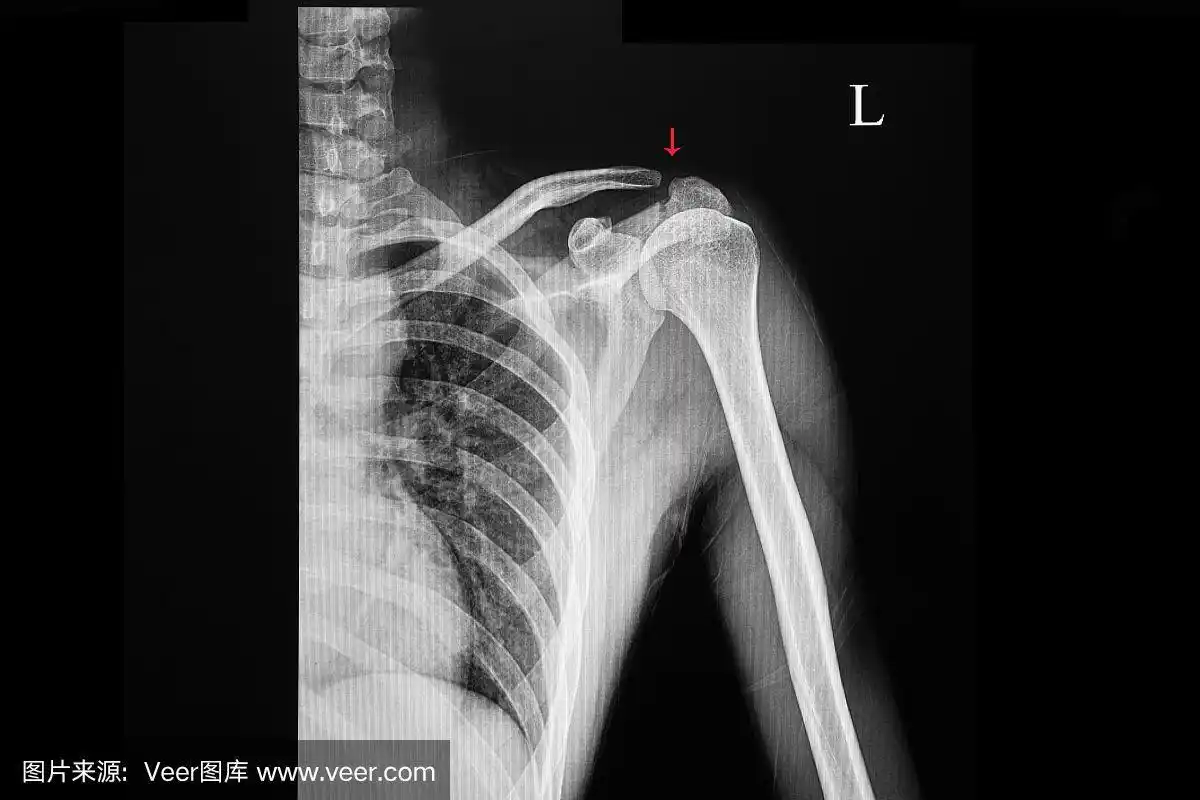 肩胛骨骨折病人的x光片
